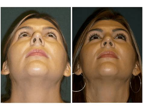 Before & After Gallery - Houston, TX: Houston Sinus Surgery