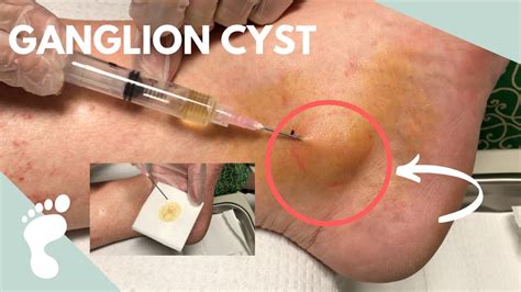 Ganglion Cyst Aspiration