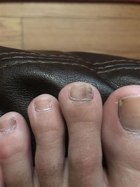 There’s a black line through my toenails and I’m worried, what is it ...