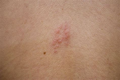 Top 19 stages of shingles rash pictures 2022