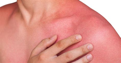 Heat rash, sun rash -- what's the difference? | OSF HealthCare