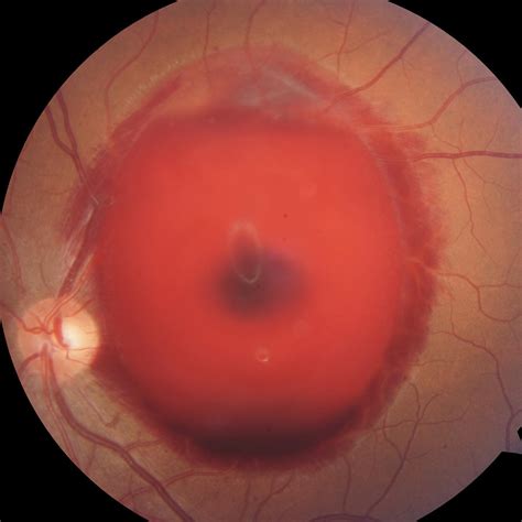 Eye_india - Valsalva retinopathy: a hemorrhagic detachment...