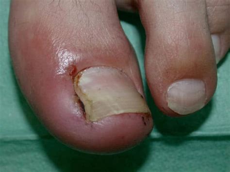 Paronychia: Causes, Symptoms, Diagnosis and Treatment | Healthtian