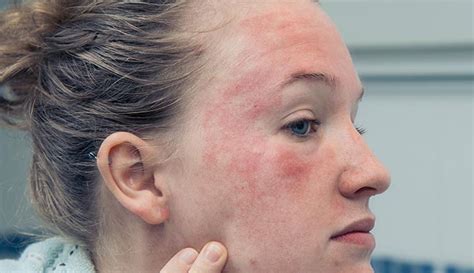 Eczema on Face: Symptoms, Causes, Types & Treatment