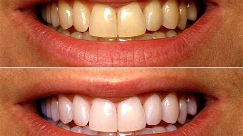 Teeth Whitening Dentist Before After - White Choices