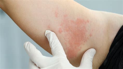 Ministre le revenu À la mode causes of hives all over body Diminution ...