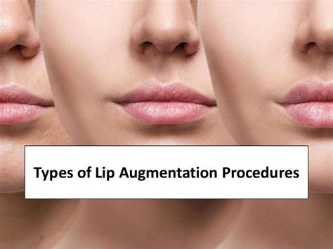 Types of Lip Augmentation Procedures