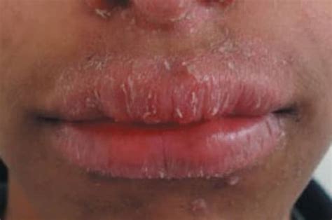 Dry Patches on Lip, Upper, Lower, Pictures, Causes, Not Cold Sore ...