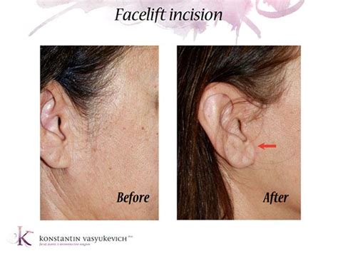 The Evolution of Facelift Incisions | Manhattan, NYC Specialist ...