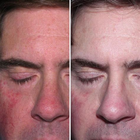 Rosacea Treatment | Before & After | Kingsway Dermatology