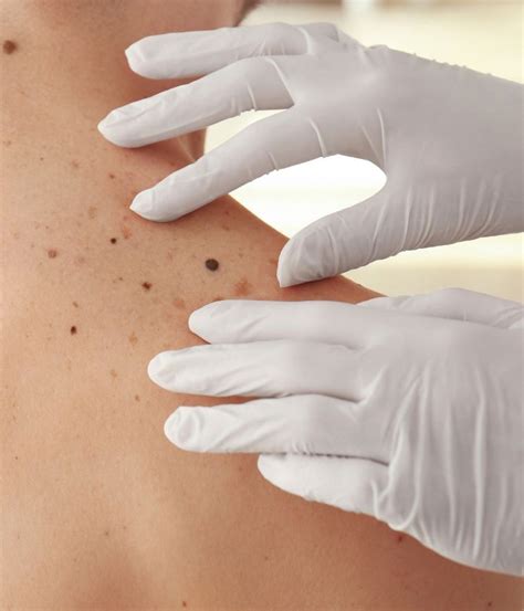 Shave Biopsy | Mesa, AZ | Sagebrush Dermatology