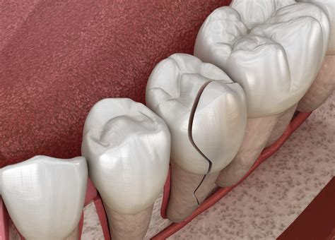 Treatment Options for a Broken Tooth – Roosevelt Dental Center