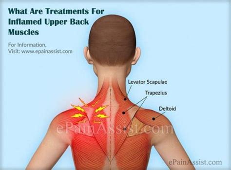 Back Pain Muscle Spasm Treatment