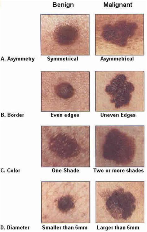 Cancerous Mole Vs Normal Mole