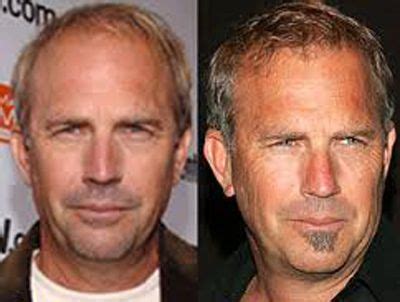 Kevin Costner Hair Transplant Plastic Surgery | Hair transplant, Kevin ...