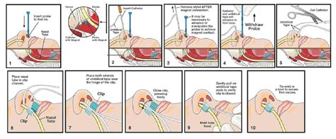 Nasal Bridle : Married to Your Tube CASE SCENARIOS - Semantic Scholar