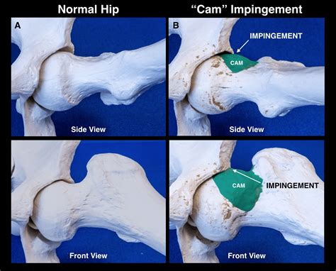 Hip Impingement Treatment | North Hollywood | Los Angeles Orthopedic ...