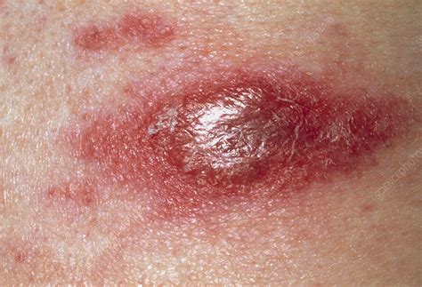 Lymphoma Skin Cancer Rash