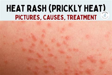 Heat Rash: Pictures, Symptoms, Causes, Types, and Treatment