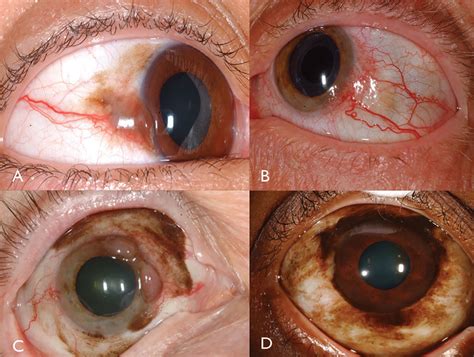 Conjunctival Squamous Cell Carcinoma