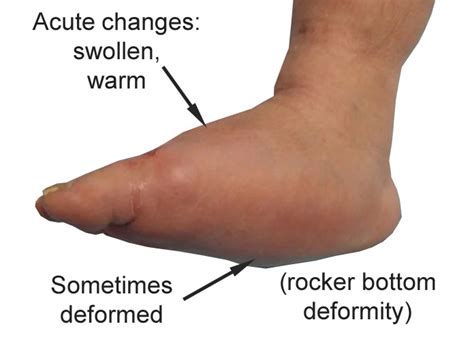 Charcot Fractures - Drwolgin