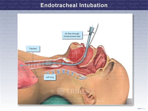 Endotracheal Intubation Anatomy