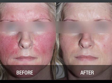 Laser Treatment For Rosacea: Types, Efficacy, Side Effects,, 47% OFF