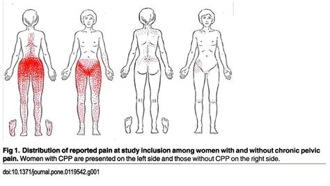 Chronic Pelvic Pain: DeMystifying Referred Pain - Foundational Concepts