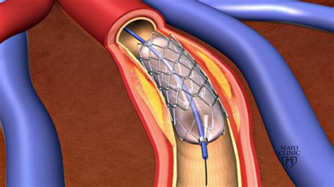 Global Coronary Stents Market $15.7 Billion by 2031