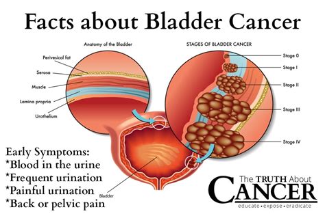 Bladder Cancer – Signs, Symptoms And Causes | Home Remedies