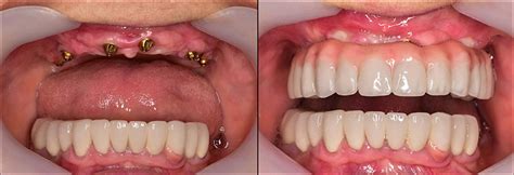 Implant Overdentures and Fixed All-On-X Treatment - Troy Dental ...