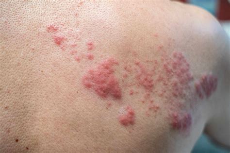 What Causes Shingles to Reactivate?