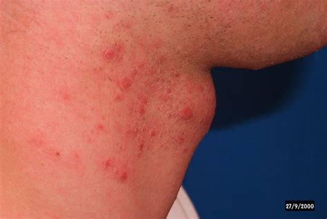 Folliculitis: Causes, Symptoms, Treatment