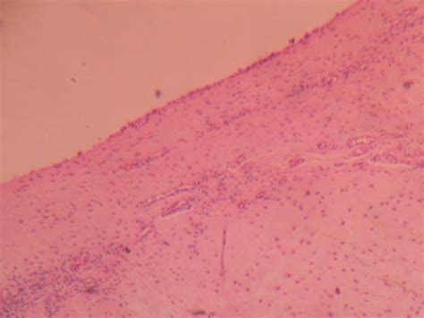 MENISCAL CYST – Histopathology.guru