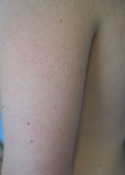 Keratosis Pilaris and Variants - Dermatology Advisor