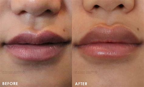 Lip Augmentation & Injections | Sydney | Bondi | Dr Mooney