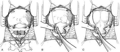 Posterior Fossa Tumors in the Pediatric Population: Multidisciplinary ...