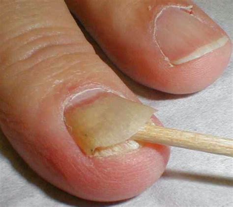 What Causes Fungal Nail Infection and How Can It Be Addressed? : Nail ...