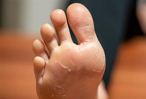 Peeling Skin On Feet: Causes, Home Remedies, And Prevention ...