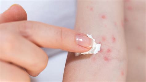 Treating An Allergic Skin Reaction (Contact Dermatitis), 46% OFF