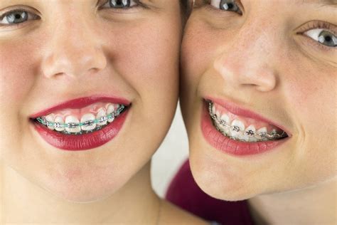 how braces work after extraction - Denice Nolan