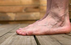 Understanding Bone Spurs on Top of Foot: Causes and Treatments