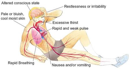 Signs and Symptoms of Shock | Med-Health.net