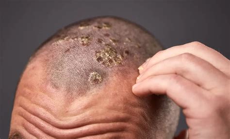 Scalp Psoriasis: Symptoms, Causes & Treatment