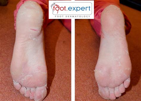 Why does skin peeling occur on the feet?