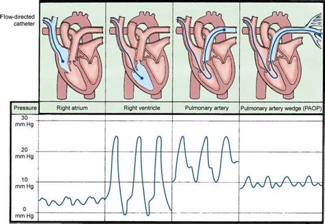 pulmanary artery pressure | Pulmonary artery catheter waves ...