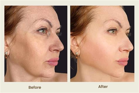 EZ Gel Plasma Filler - Newport Beach CA | PCH MedSpa