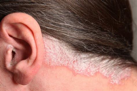 Scalp Psoriasis Treatment At Pine Belt Dermatology & Skin Cancer Center