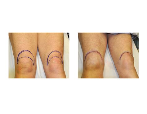 The Knee Lift for Unsightly Suprapatellar Skin Folds - Explore Plastic ...