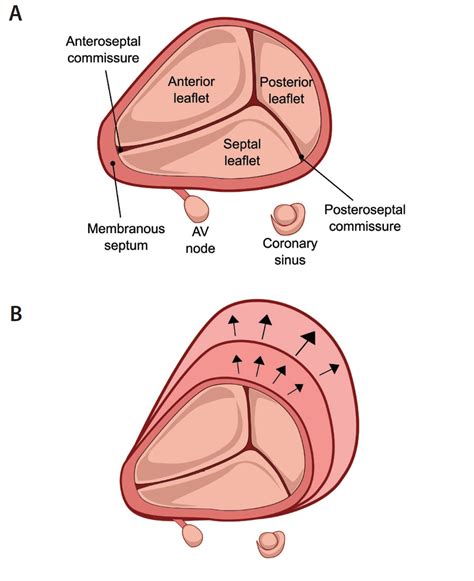 Transcatheter Tricuspid Valve Therapies - Cardiac Interventions Today